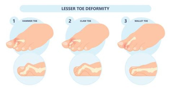 What does Lesser toe mean?